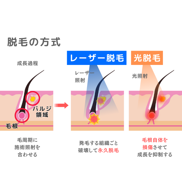 メンズ脱毛の施術方式